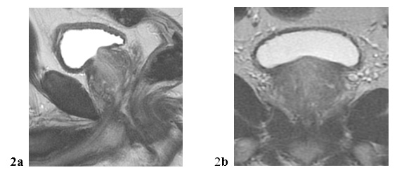 Prostatın MR görüntülerinde farklı kesitlerde değerlendirilmesi