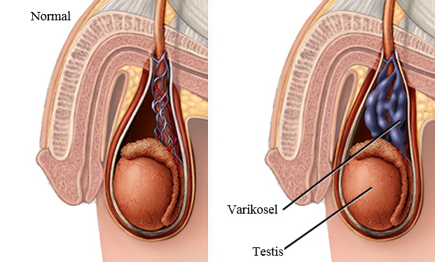 Varikoselin anatomik şeması